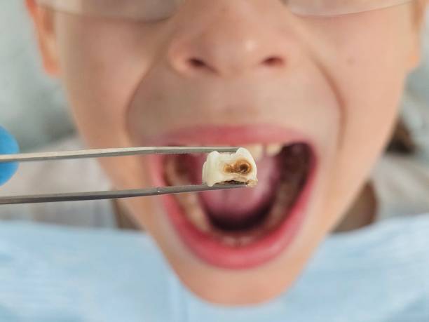 Best Emergency Dental Care for Abscessed Tooth in Leavenworth, KS